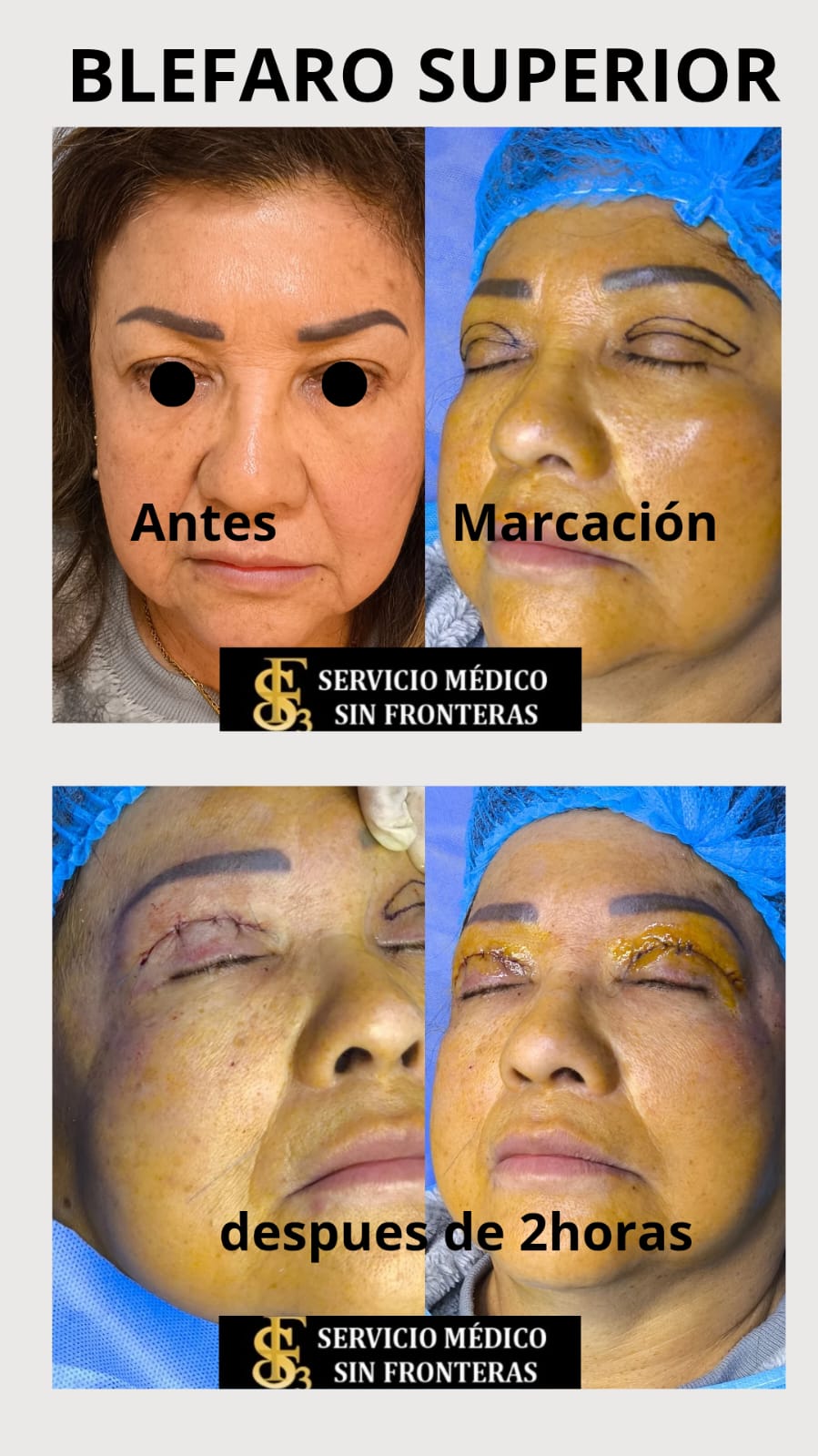 Blefaroplastia